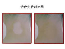 泛发型白癜风有哪些表现